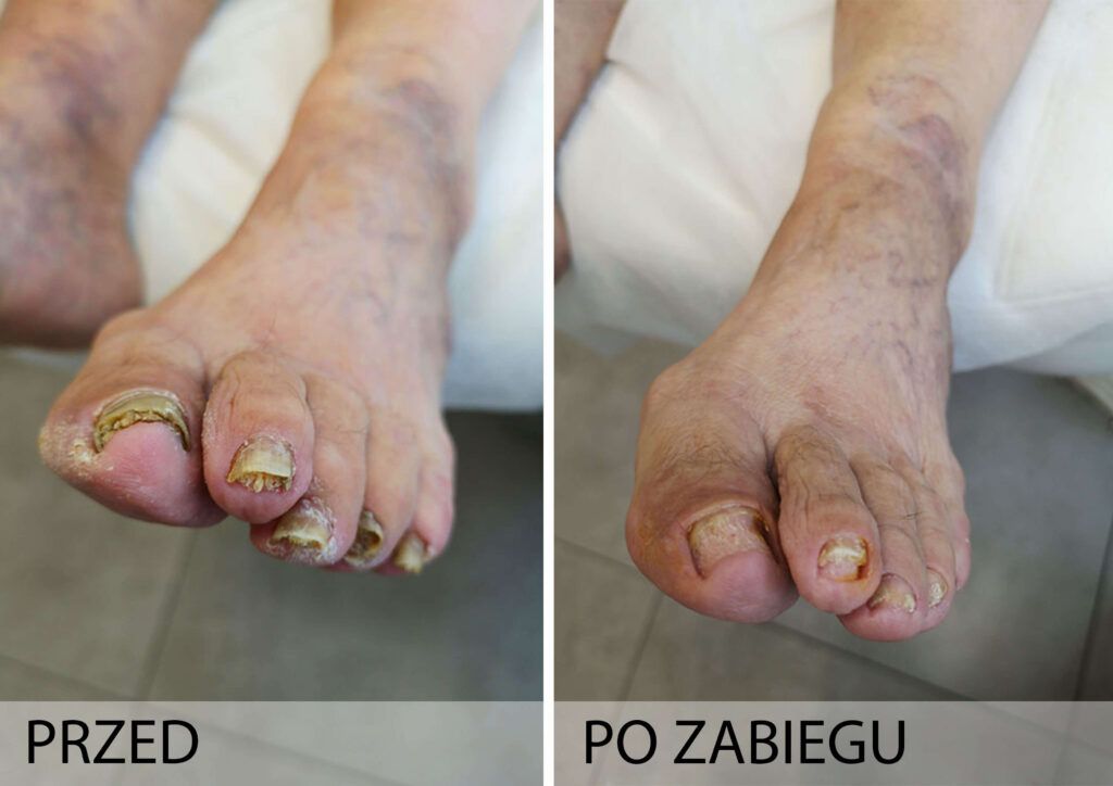 Grzybica paznokci przed i po zabiegu
