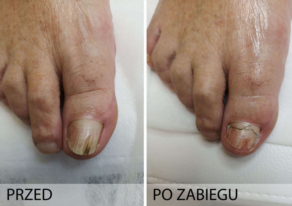 Grzybica paznokci przed i po zabiegu