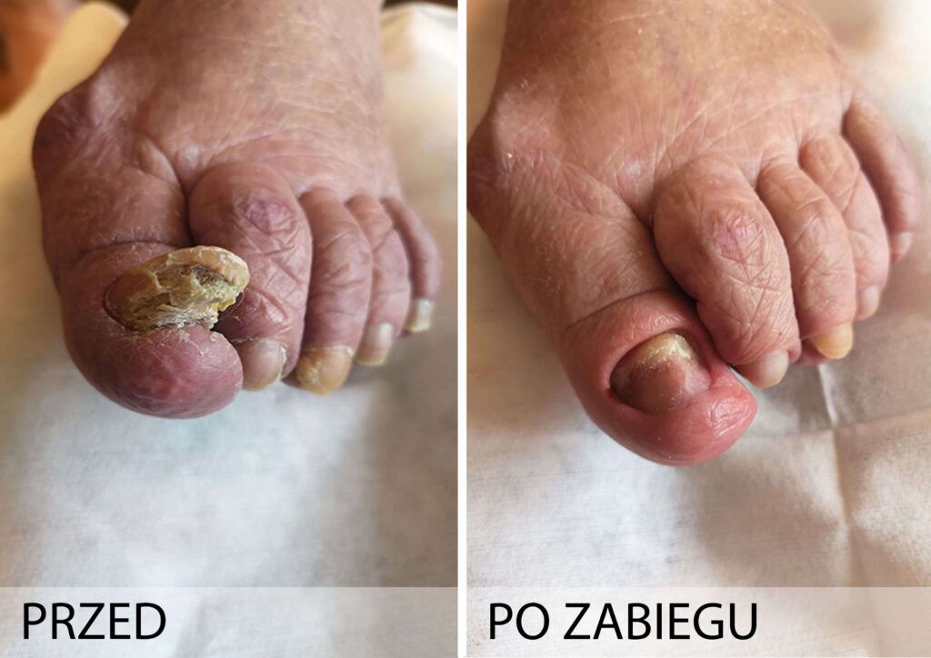Grzybica paznokci przed i po zabiegu